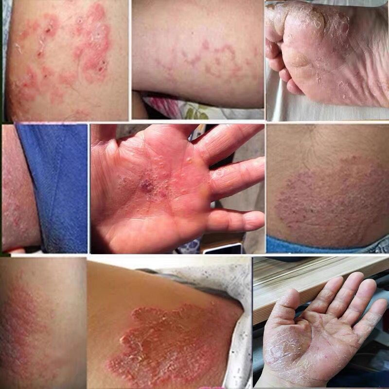 【旗舰品质】京康恩湿痒痒小泡藓汗泡诊手京康恩皮肤