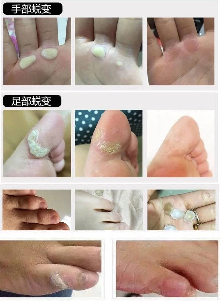 茧立净去老茧子手脚厚茧皮脚底脚垫死皮膏清关节脚趾老茧