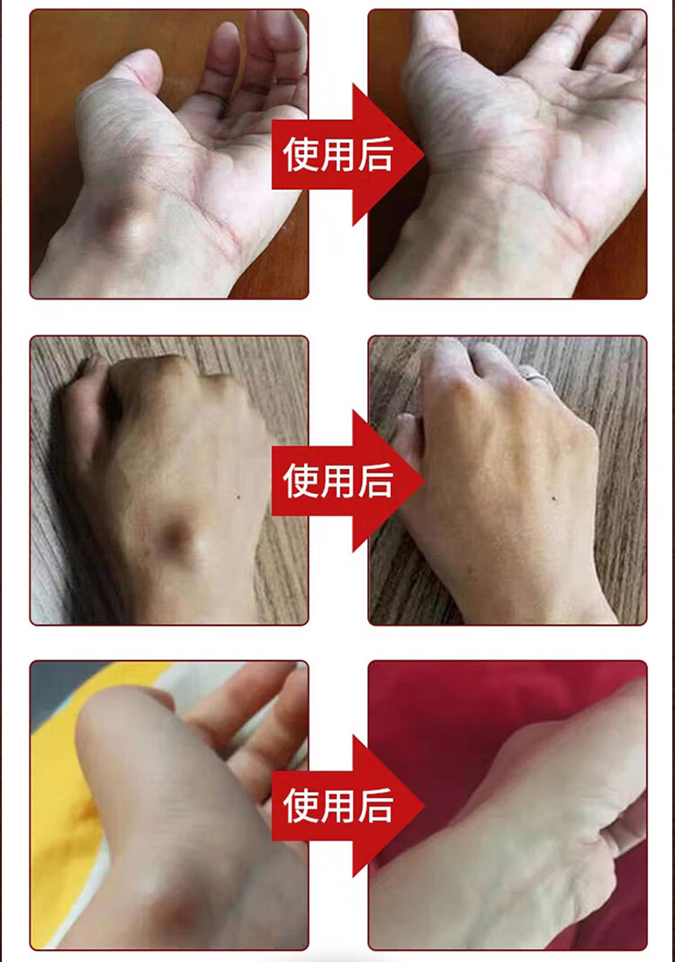 【发顺丰快递】云泰华益乐丰柯瑞森一号腱鞘大拇指肩