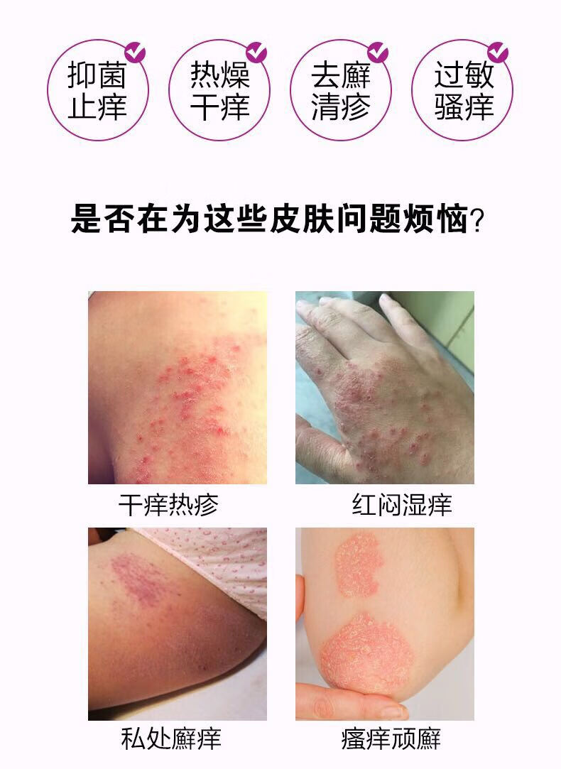 三珍清紫椒廯酊净牛皮头去瘙皮肤瘙痒止痒全身适用外用一瓶体验装