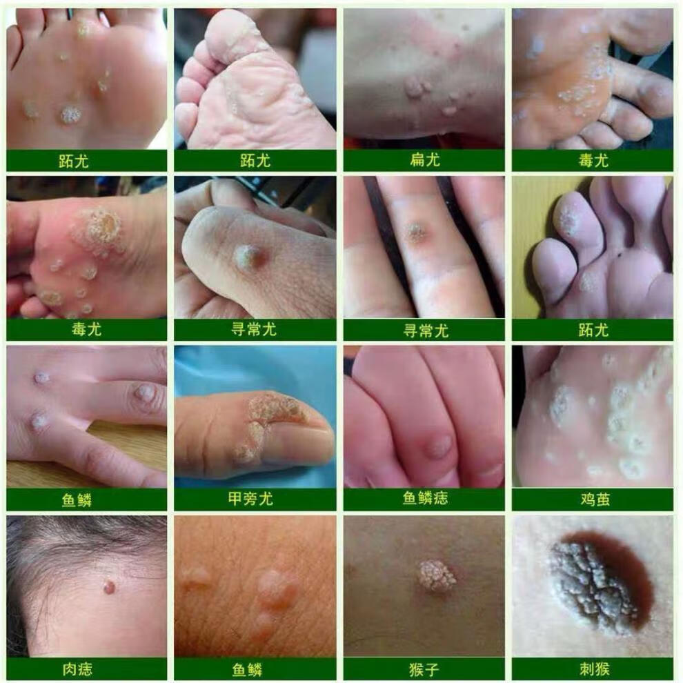 【官方旗舰】寻常i疣去除膏去脖子小肉粒【尤猴克星】液腋下劲部赘皮