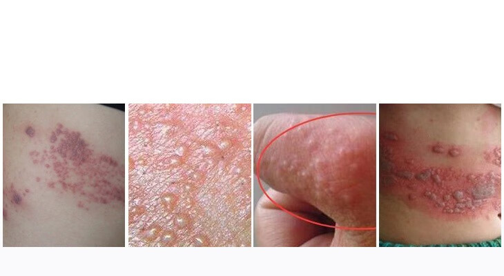 d型7号胡克蛇带状蛇缠腰皮肤外用