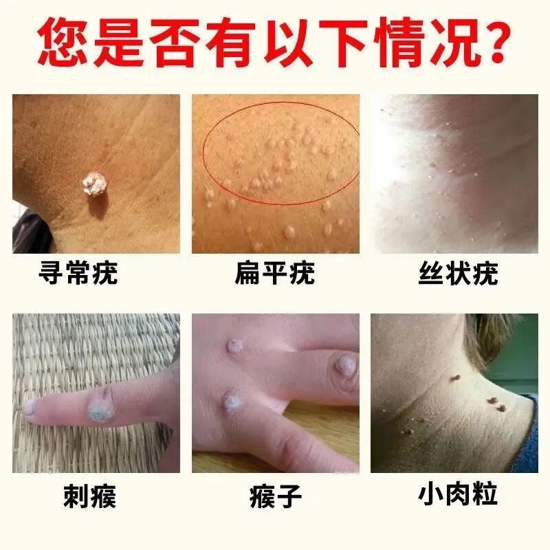 【京选优品】【专攻去疣】去除脖子小肉粒赘皮扁平尤祛疣瘊丝状尤腋下