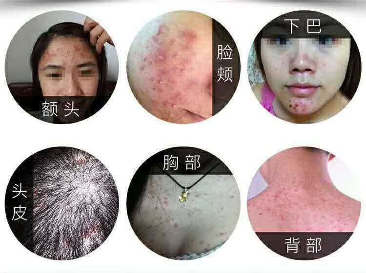治马拉色菌毛囊炎的药膏头皮炎湿疹胸前背部脓包痤疮痘痘疙瘩止痒 发9