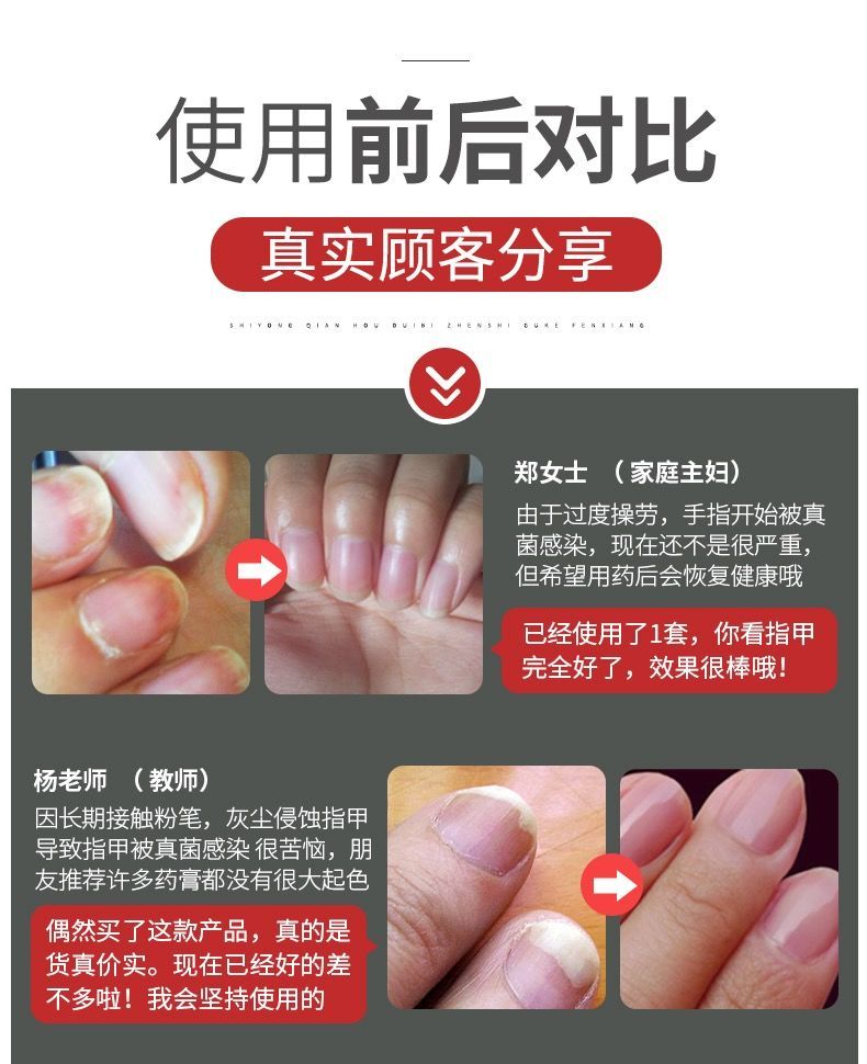 灰指甲根诒灰甲王去除灰指甲专用抑菌液亮甲专用一瓶修复液