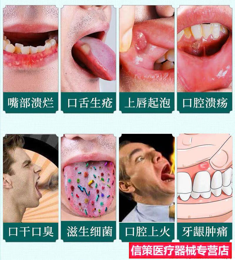 冰硼散止痛口腔溃疡喷雾液喷剂一点灵复发性口疮凝胶儿童药水 (拍1 1)