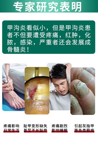 甲沟炎 脚趾软甲消肿去肉芽嵌甲治疗手指甲勾软化剂水神器 四盒巩固装