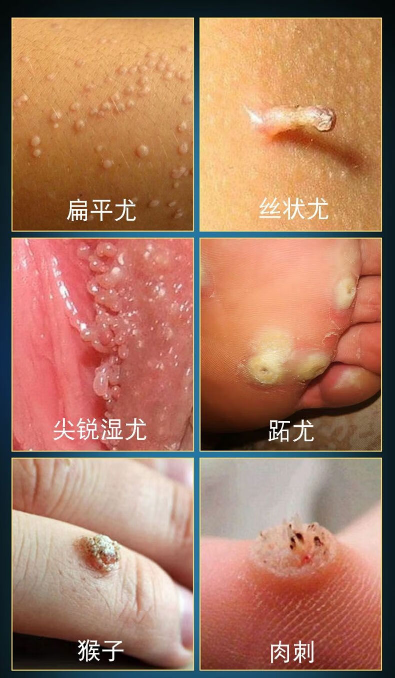 祥医堂扁平疣面部专用干扰素凝胶丝状疣鸦胆子去疣草本乳膏 2盒【图片