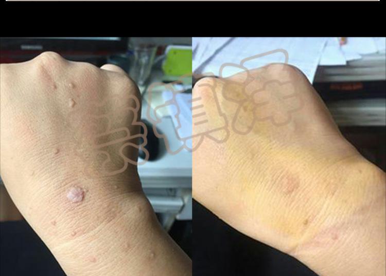 去除丝状疣治疗祛疣瘊子疣必治去扁平疣中药软疣面部去除膏手背手部