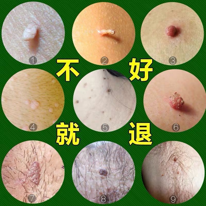 【京选优品】去l疣神器去脖子小肉粒克尤液颈部腋下小猴子去质膏赘皮