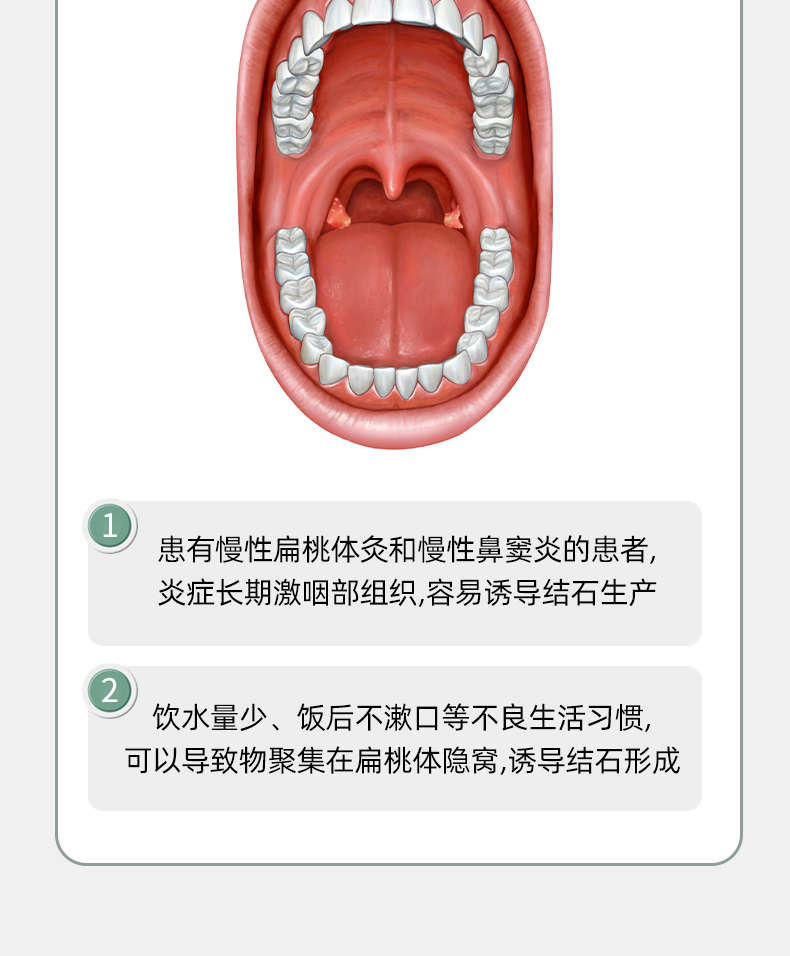 扁桃體結石去除工具扁桃體結石去除工具隱窩可視吸取器口腔掏取扁桃體