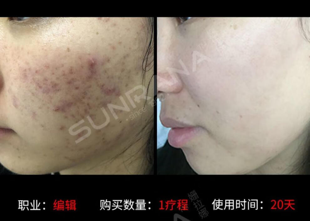 姗拉娜祛痘膏祛痘棒淡化痘印凝胶去痘疤痘坑修复粉刺闭口男女雅慕诗婷