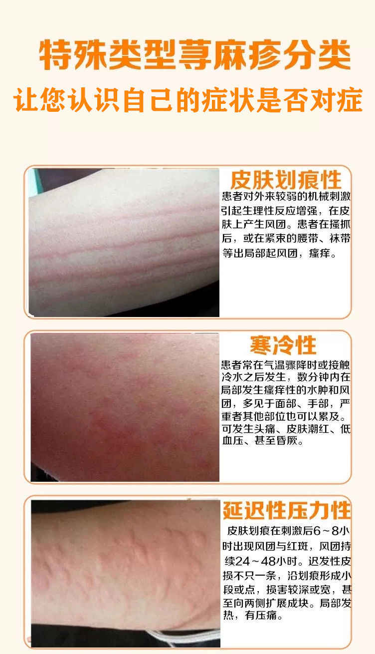 艾草克敏霜荨蔴疹皮肤瘙痒干燥过敏风团皮l炎湿l疹专用止痒膏 一盒