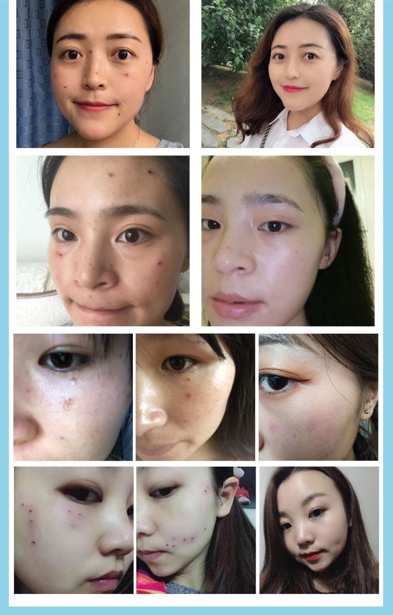 点痣疤痕脸部激光去祛点痣斑纹眉后脸部液凹坑防疤膏去红印修复黑印