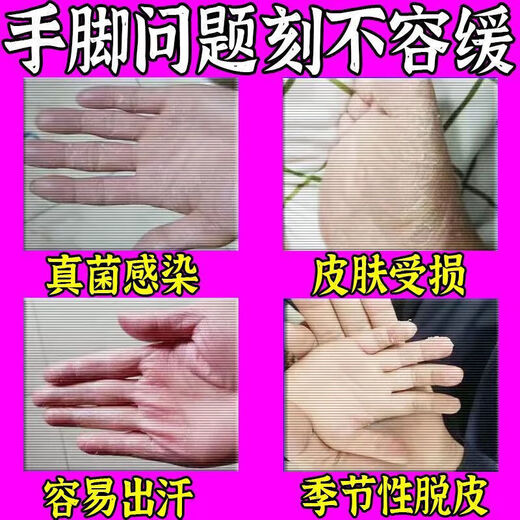 Yunnan Materia Medica Hand and Foot Peeling Antibacterial Cream Seasonal Hand Peeling Finger Palms Sloughing, Cracking, Cracking, Skin Blistering Fungal Infection Hand and Foot Peeling Cream 20g One bottle sent 1 bottle/box