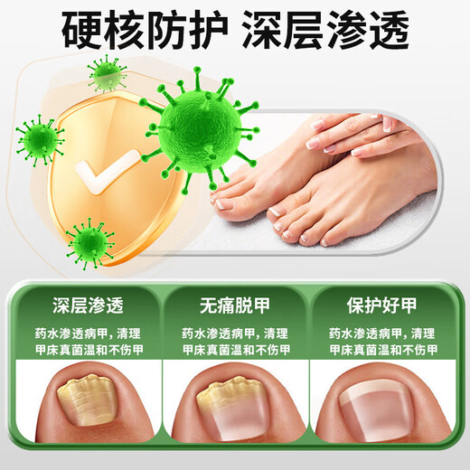 Yunnan Materia Medica Special Effect Chinese Herbal Antibacterial Liquid for Onychomycosis, Thickening, Yellowing and Empty, Anti-Analysis Water, Special Effect Kit for Onychomycosis