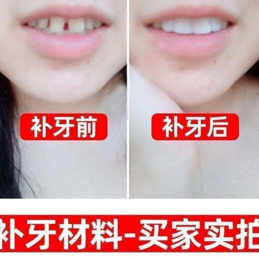 奇力康补牙齿神器材料自己在家补牙自粘补牙神器补牙材料临时补牙缝 967倍效【补15颗牙】爆丨款坚固不掉