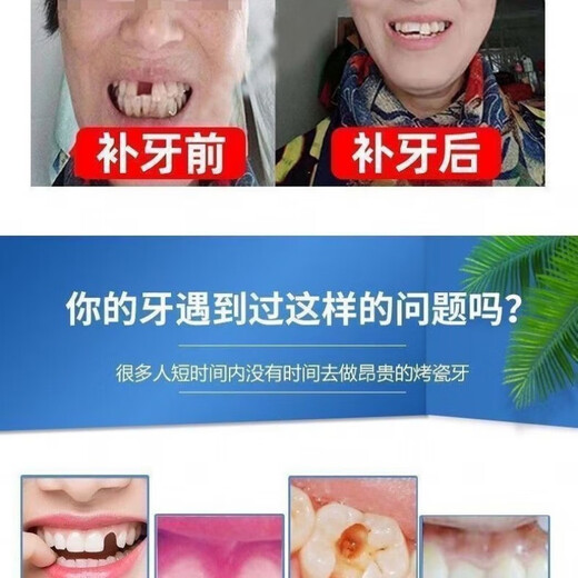 奇力康补牙齿神器材料自己在家补牙自粘补牙神器补牙材料临时补牙缝 967倍效【补15颗牙】爆丨款坚固不掉