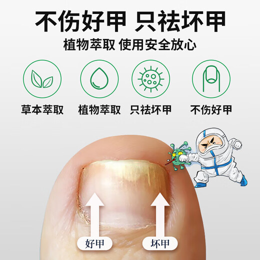 Yunnan Materia Medica Special Effect Chinese Herbal Antibacterial Liquid for Onychomycosis, Thickening, Yellowing and Empty, Anti-Analysis Water, Special Effect Kit for Onychomycosis