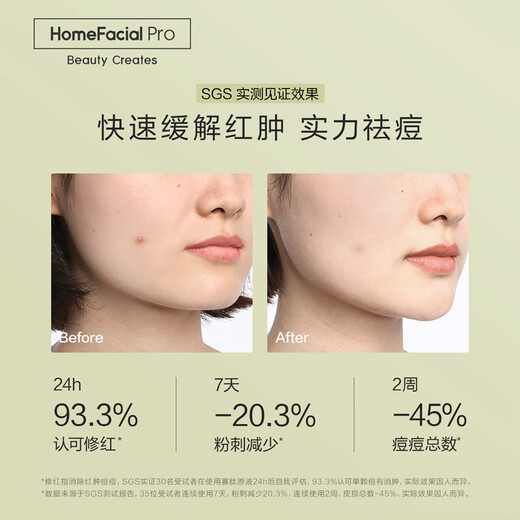 Pre-sale HomeFacialPro HFP oligopeptide anti-acne original solution essence to remove acne marks, repair acne pits, remove acne and blackheads for women and men, 4 bottles