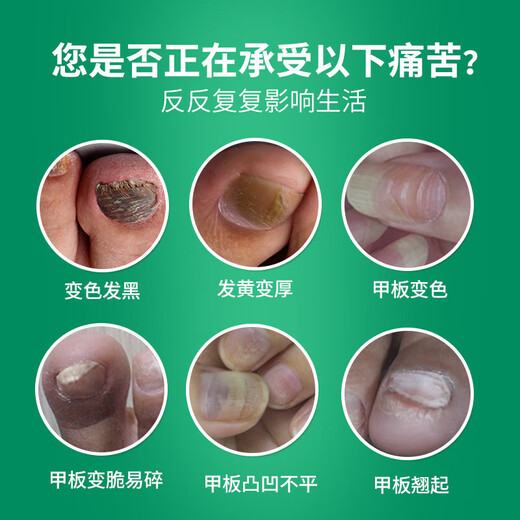 Yunnan Materia Medica Special Effect Chinese Herbal Antibacterial Liquid for Onychomycosis, Thickening, Yellowing and Empty, Anti-Analysis Water, Special Effect Kit for Onychomycosis