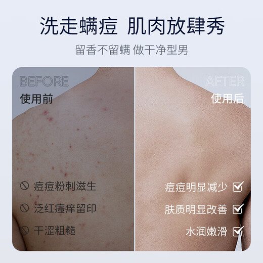 SUMDOY Japan imported fruit acid shower gel to remove mites and remove mites and control oil to relieve itching and moisturizing moisturizing and long-lasting fragrance for men and women [Save 70 yuan immediately] Mite-removing shower gel *2