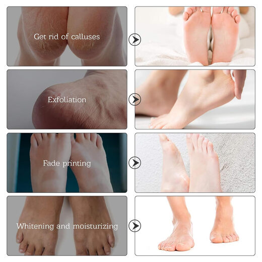Dr.Pedi foot exfoliating mask, natural exfoliation, suitable for dry dead skin, cracked feet, and calluses
