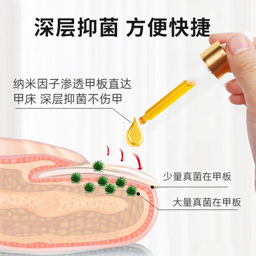 Yunnan Materia Medica Special Effect Chinese Herbal Antibacterial Liquid for Onychomycosis, Thickening, Yellowing and Empty, Anti-Analysis Water, Special Effect Kit for Onychomycosis