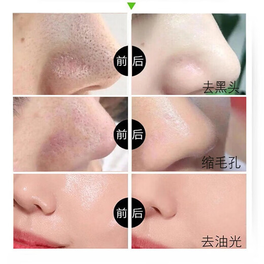 Image beauty removes blackhead cleaning tool for deep cleaning tear and sucking nose mask mud acne pores and acne men and women shrink 2 packs [Promotional package]