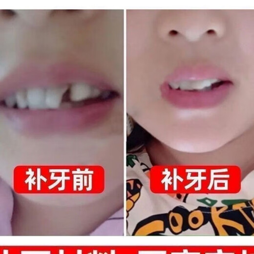 奇力康补牙齿神器材料自己在家补牙自粘补牙神器补牙材料临时补牙缝 967倍效【补15颗牙】爆丨款坚固不掉