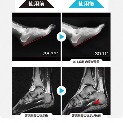 Xuena Rui Heel Pain Plantar Fasciitis Achilles Tendonitis Arch Pad Heel Pain Relief Pad Bone Spur Pain Rear Heel Pad 1 Pair Full Pad M Size 39-42 Size Can Be Trimmed