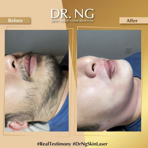 Household hair removal instrument for men, beard removal, beard removal, laser freezing point hair removal instrument for men, painless whole body beauty salon, women with sweaty lips, chest and leg hair, enhanced version white (high power, can be used all over the body with beards)