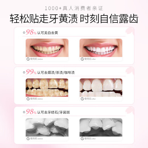 娅洛思樱花炫白牙贴7对14片装去黄去渍防渍轻松美齿7天牙齿显著亮白