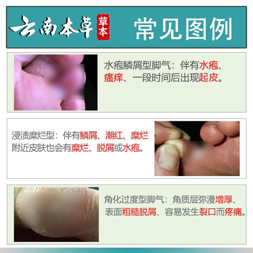 Yunnan Materia Medica, athlete's foot, foot odor relief, soothing itchy feet, rotten odor, fungal infection, skin antibacterial spray 60ml + cream 20g