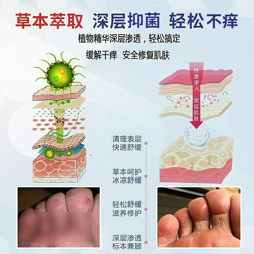 Yunnan Materia Medica, athlete's foot, foot odor relief, soothing itchy feet, rotten odor, fungal infection, skin antibacterial spray 60ml + cream 20g
