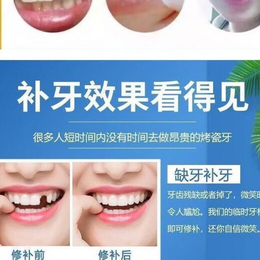 奇力康补牙齿神器材料自己在家补牙自粘补牙神器补牙材料临时补牙缝 967倍效【补15颗牙】爆丨款坚固不掉