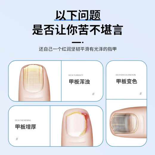 Japanese onychomycosis special effect medicine for brightening onychomycosis i cures authentic fungal infection, brightens onychomycosis, imported antibacterial, buy 2 get 1 free, 80% of customers choose the upgraded version, special for brightening thick onychomycosis, Jingdong Pharmacy