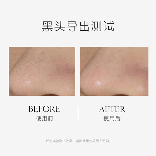 Youyi (unny Club) Mitesser entfernen Nasenpflaster Export flüssige Essenz Männer und Frauen T-Zonenpflege Akne-Saug- und Porenschrumpffolienset neu verbessertes Nasenpflaster 1 Box Early Adopter Pack