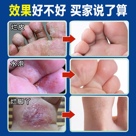 Nanjing Tongrentang athlete's foot spray to relieve itching, peeling, rotten feet, fungal infection, sweaty feet, foot odor spray, wolfsbane spray
