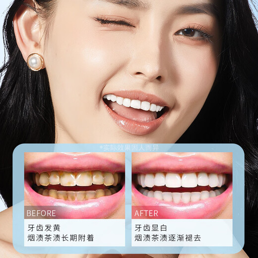 Dentist whitening patch teeth whitening teeth cleansing pen yellow teeth stains smoke teeth applying white teeth patch cleaning teeth cleansing and cleansing tone. One experience set of teeth cleansing pen
