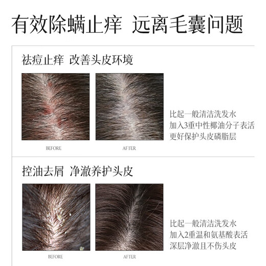 NOUGAT imported hair follicle cleaning shampoo, anti-dandruff, anti-itchi, control oil, mites, fluffy, acne inflammation shampoo for men and women