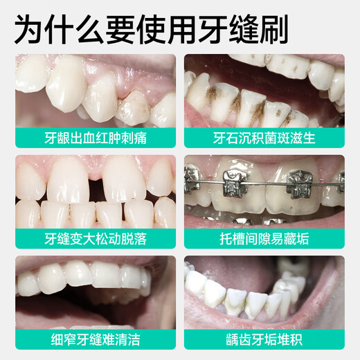 Meyarn interdental cepillo L en forma de L 20 mm 20 piezas, cerdas suaves, alambre de acero importado de corrección de dientes de corrección de ortodoncia