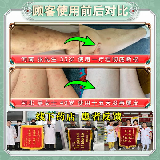 Peking Union Medical College, anti-itch, anti-bacterial, skin itching, body itch relief, 100% effective eczema, fungal infection, rash allergies, no recurrence, a box of Japanese anti-itch spray, no recurrence of eczema rash