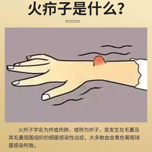 Fire boil ointment for pimples on the back of the neck, white hard lumps, pustules, redness and pus, gas pimples, acne, hard fat lumps, cysts, sores, small area burns, skin disease medicine, erythromycin ointment 1 box