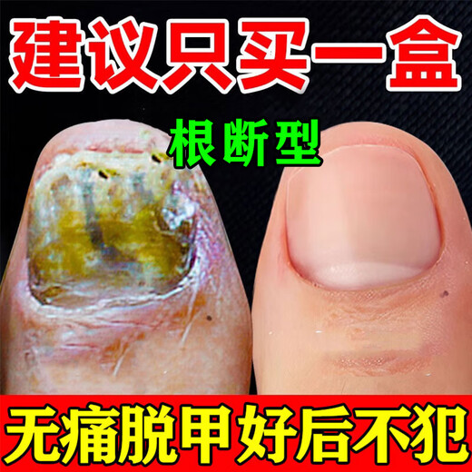 Special effects on onychomycosis. Nail thickening, yellowing, thickening and emptying. Fungal infection. Original imported from Japan. Onychomycosis ointment. 1 box. What is the best medicine for onychomycosis in Jingdong store? Quick onychomycosis special ointment room