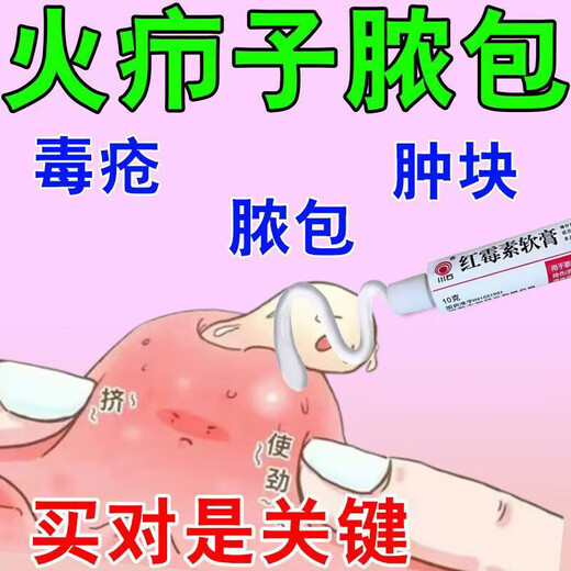 Fire boil ointment for pimples on the back of the neck, white hard lumps, pustules, redness and pus, gas pimples, acne, hard fat lumps, cysts, sores, small area burns, skin disease medicine, erythromycin ointment 1 box