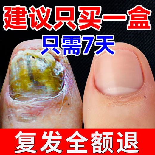 The No. 1 onychomycosis effect in Hong Kong Pharmacy, special nail fungus infection, yellowing and thickening of onychomycosis, impatiens antibacterial liquid, 2-5 onychomycosis, highly recommended, 69% people choose 3 boxes
