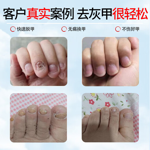 Tongrentang Onychomycosis Special Nail Fungus Infection Removal, Bad Nails, Bright Nails, Onychomycosis, Net Yellowing, Thickening and Empty 30ml