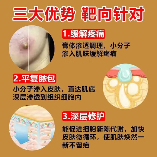 Fire boil ointment for pimples on the back of the neck, white hard lumps, pustules, redness and pus, gas pimples, acne, hard fat lumps, cysts, sores, small area burns, skin disease medicine, erythromycin ointment 1 box