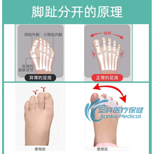 【JD健康】婴儿童脚趾头小孩大拇指外翻矫正器宝宝重叠分离器分趾母内扣821+食+中(2-9岁)均码 831大拇指+食指+中指(1-4岁)